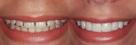 Niezawodne sposoby na skuteczne wybielanie zębów